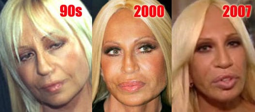 donatella versace - a before and after  Celebrity plastic surgery, Donatella  versace plastic surgery, Plastic surgery