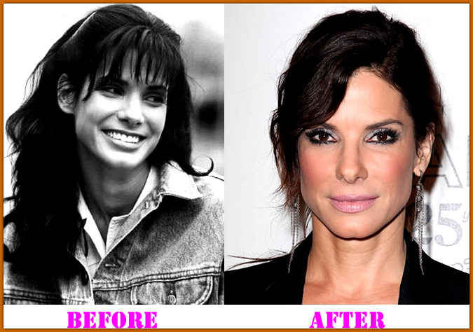 Sandra Bullock Plastic Surgery Before And After Celeb Surgerycom