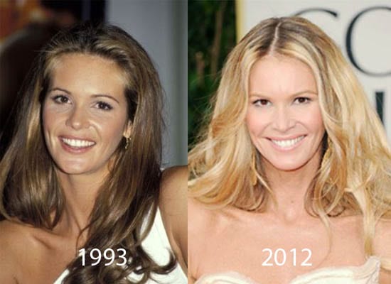 Elle Macpherson Plastic Surgery Before and After - CELEB-SURGERY.COM.