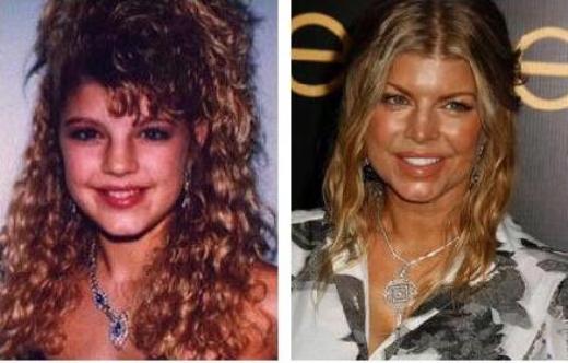 Fergie Plastic Surgery Before And After Celeb Surgerycom
