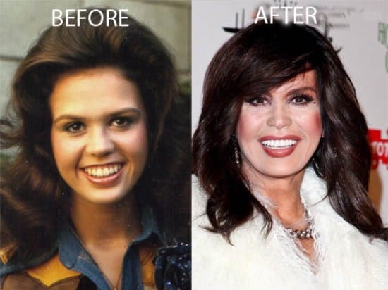 Marie Osmond Plastic Surgery Before And After Celeb Surgery