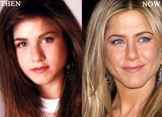 Jennifer Aniston Nose Job Photo Before and After.