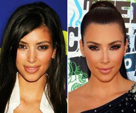 Kim Kardashian Plastic Surgery Photo Before And After 