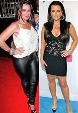 Kyle Richards Plastic Surgery Photo Before and After ...