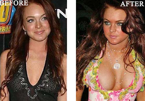Lindsay Lohan Breast Implants Photo Before and After - CELEB-SURGERY.COM.